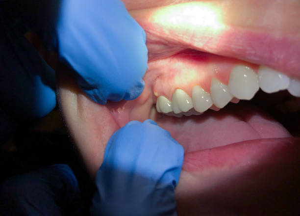 Best Dentist for Tooth Abscess  in Akron, PA